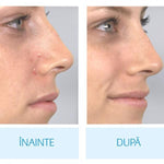 Aspirator facial, pentru un ten curat